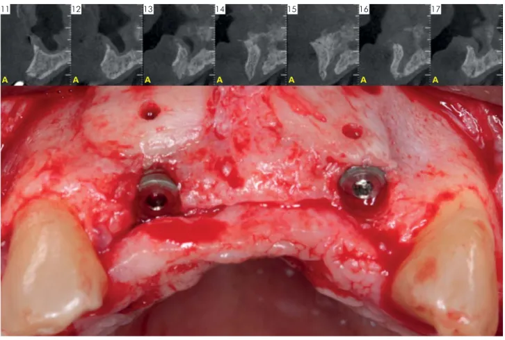 Figure 1 illustrates the outcome of a graft procedure  in a defect that had some amount of cancellous bone  (Group P), treated with an allograft biomaterial