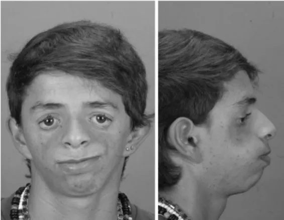 Figure 2. Patient with Treacher Collins syndrome and  with normal, unaffected ears.