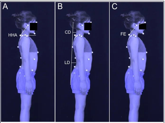 Table 1 shows a multiple model proposal based on anamnesis  for MB diagnosis. Six variables were selected for single regression  and, of these, two remained in the multiple model, which were  nasal obstruction (OR 5.55) and pacifier use (OR 1.25), both  as