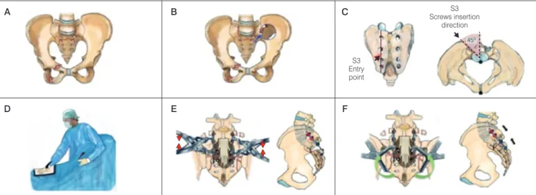 Table 1. Implants used in osteosynthesis.