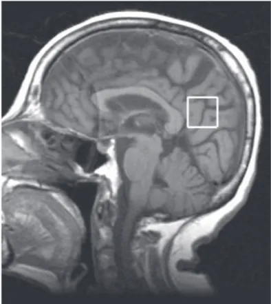 Figure 1. Sagittal  T1-weighted  image  (TR=450  ms,  TE=8  ms),       showing voxel in the posterior cingulate.