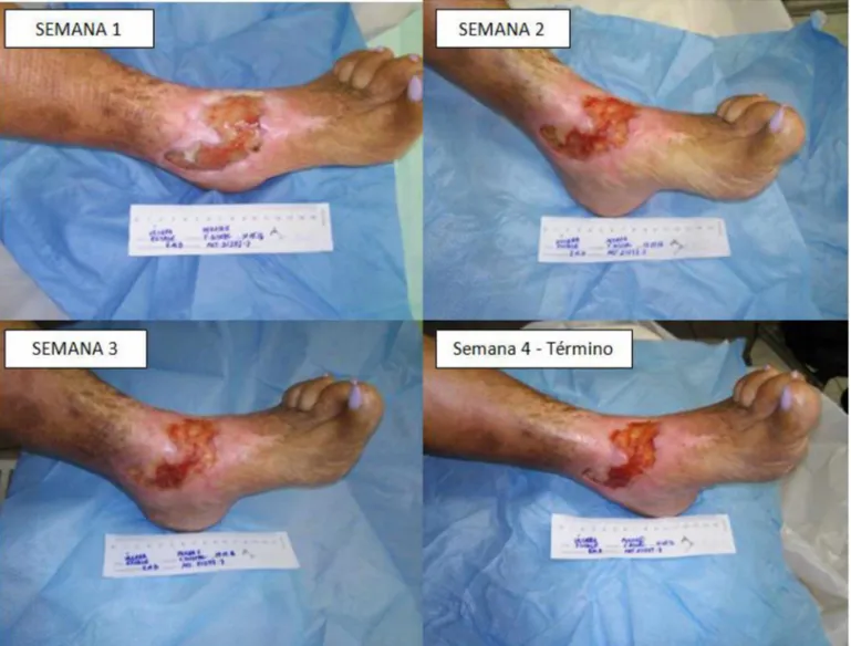 Figura 10 -  Exemplo de paciente tratado com ALGINATO COM PRATA (GRUPO 3) - -SEMANAS 1 à 4