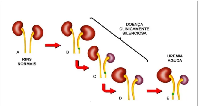 Figura 1. A - Anatomia renal e ureteral normais. B - A obstrução aguda do ureter pode ter como consequência o  aumento do ureter (hidroureter) e rim (hidronefrose) correspondente