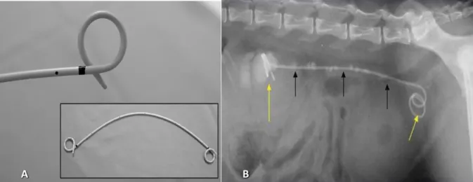 Figura 7. A - Stent do tipo duplo pigtail. B - Visualização in situ do stent ureteral, com uma extremidade dentro  da pélvis renal e outra a nível vesical (setas amarelas), e de ureterólitos (setas pretas) (Retirado de Chew e Denstedt,  2006 (A); Hattersle