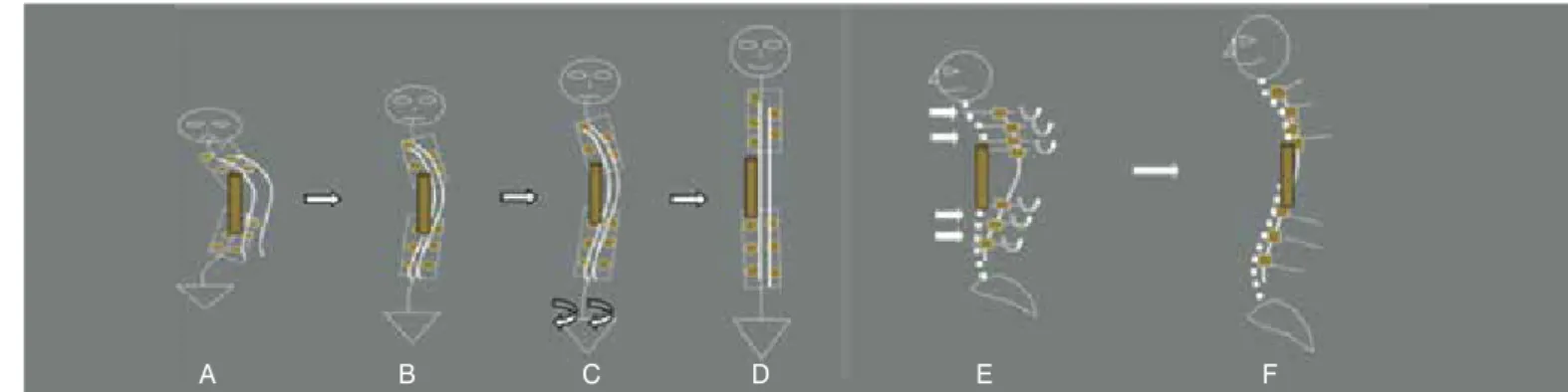Figure 1. Depiction of the indirect derotation maneuver in the frontal (A-D) and sagittal (E,F) planes (explanation in the text).