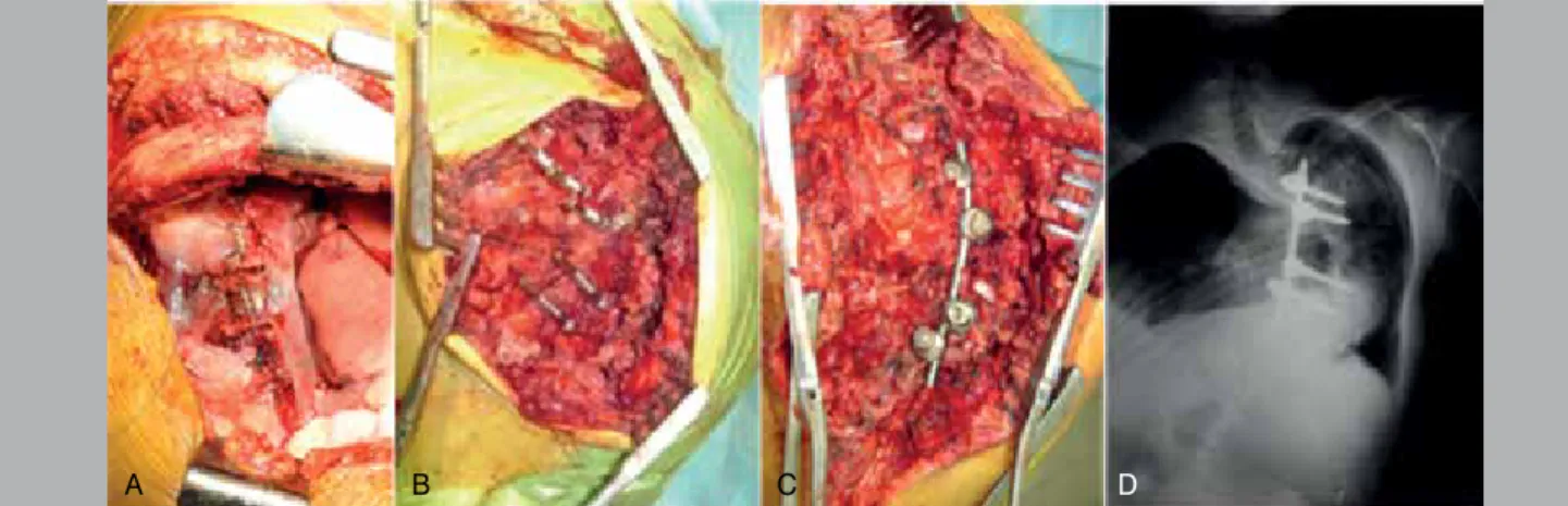Figure 6. The first stage of surgical intervention: Thoracotomy, release of intervertebral structures at the apex of deformity (A), installation of apical short rod  at T8-L1, radiograph of the spine after stage 1 (D).