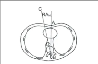 Table 2. Comparative table of groups of patients with pedicle screw (A) and  hybrid (B) fixation of the spine.