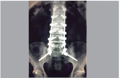 Figure 3. Postoperative view of long instrumentation with iliac fixation. Lateral  radiograph.