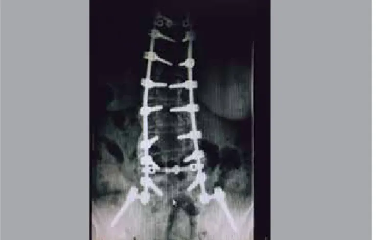 Figure 6. Postoperative – Long instrumentation with iliac screws connected to  the rods through lateral connectors