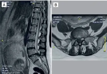 Figure 1. MRI before surgery (L5-S1 LDH). Sagittal (A) and axial (B) planes.