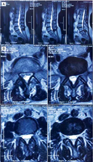 Figure 2. A. MRI, 1 year after surgery. Sagittal plane; B. MRI, 1 year after  surgery