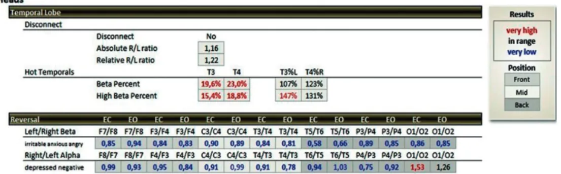 Figure 3. Percentage quantity above the expected beta wave (15-23 Hz >17%) and Beta-High (23-38 Hz >10%) at the T3 and T4 points   of the 10-20 electroencephalography system in a summary statistical distribution (TQ-7 analyze page), expressed in red 