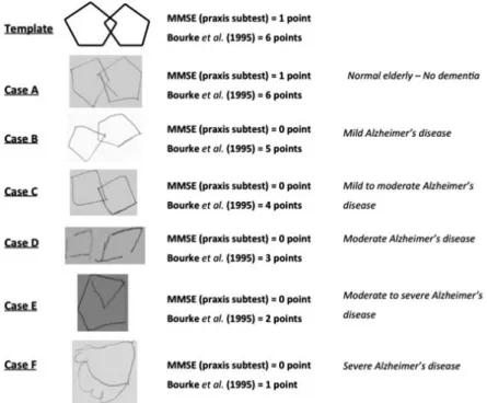 Figure 1. Template and clinical examples of the  Pentagon Drawing Test in preserved older adults  and Alzheimer’s dementia.