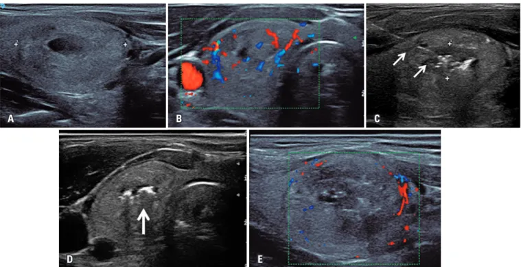 Figure 1. Ultrasonography of thyroid after procedure showing absence of central vascularization