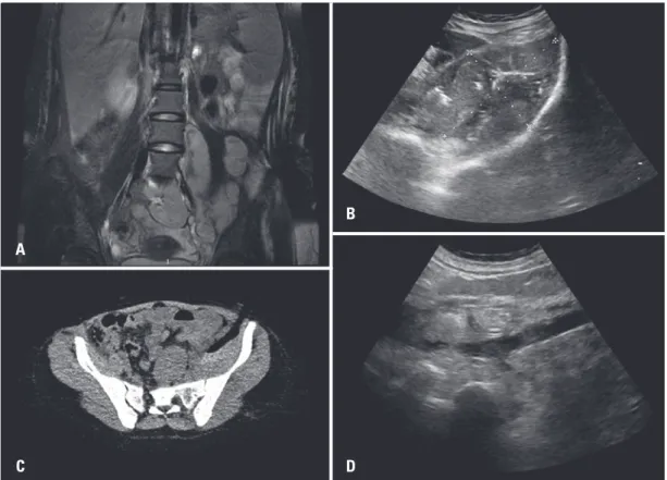 Figure 1. Percutaneous computed tomography-guided drainage using Seldinger technique. (A) Contrast-enhanced abdominal computed tomography showed a small  fluid collection inside right psoas (arrow), (B) Final imaging control demonstrating well positioned D