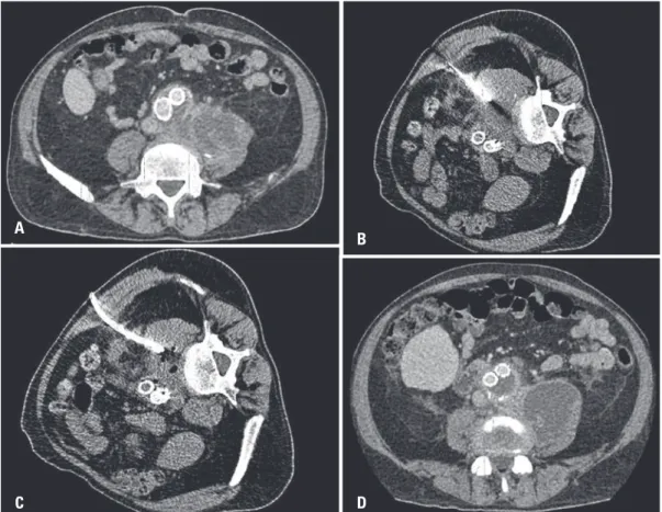 Figure 3. Contrast-enhanced abdominal computed tomography. (A) A fluid collection inside left psoas, surrounding aortoiliac graft, (B) Percutaneous computed  tomography-guided drainage was performed using Seldinger technique, (C) Final imaging control demo