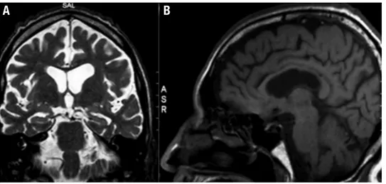 Figure 3. Brain MRI showing: 