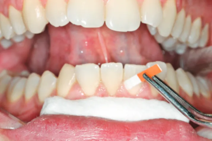 Figure 1 - Samples were collected from the vestibular face of lower central 