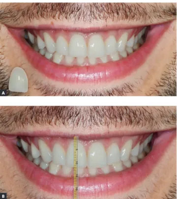 Figure 3 - A) Keynote mask; B) Maxillary right central incisor with  increase of  1mm performed with Keynote mask.