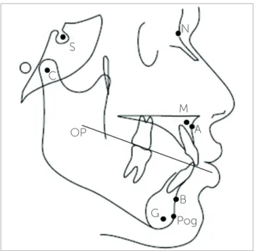 Figure 1 - Cephalometric landmarks and the occlusal plane.