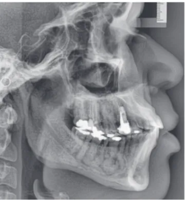 Figure 4 - Other radiographic findings of same clinical case with florid  cemento-osseous dysplasia seen for evaluation of possible  orthodon-tic treatment