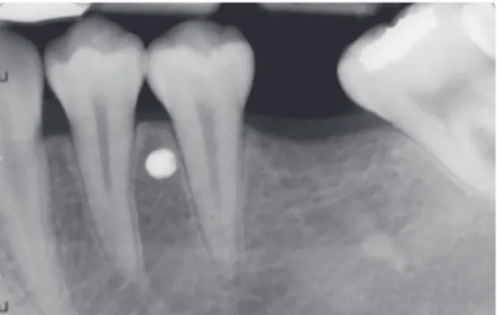 Figure 4 - Uprighting spring attached to the head of the mini-implant.