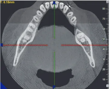 Figure 5 - 11 × 5-cm CBCT section of the mandible.
