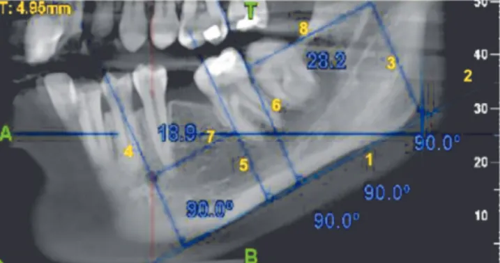 Figure 8 - Calculation of the extrusion of the second molar in the vertical  plane.