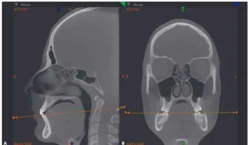 Figure 3 - CBCT images illustrating the max- max-illa in multiplanar sections. A) Sagittal section