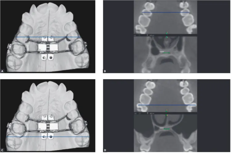 Figure 4 - A) Dental cast illustrating the delineation of reference line (in blue) passing through the miniscrews fixation rings at the mesial region of the expanding  screw, extending to the second premolars