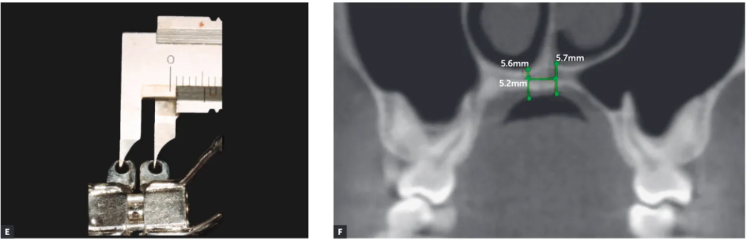 Figure 4 (continuation) - E)  Measurement of width between the miniscrews fixation rings of the expanding screw, assessed with a caliper