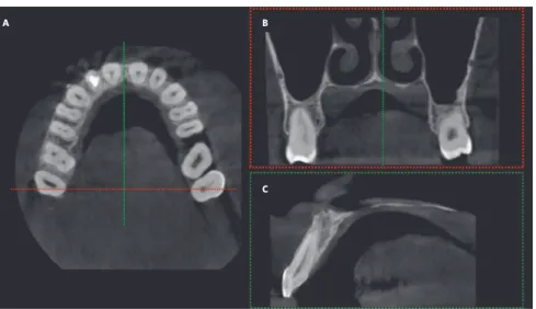 Figure 8 - CBCT images. A) Axial section. B) Coro- Coro-nal section at the region of dotted lines (in red, in A)