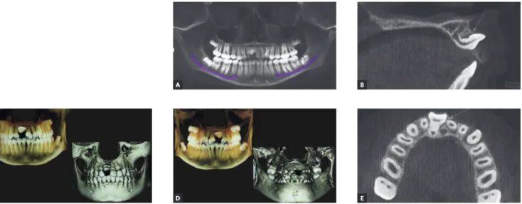 Figure 3 - A) 3-D reformation: Tru-Pan view. B) Pretreatment CBCT image with 3-D reconstruction in sagittal plane, showing severely dilacerated root of the  impacted incisor with a crown-root angle of 100 o 