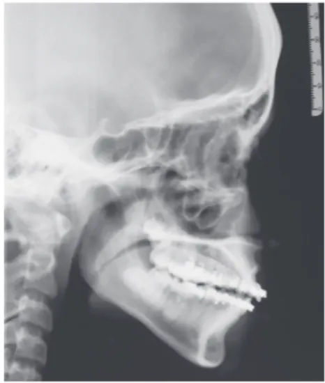 Figure 6 - Post-alignment IOPA x-ray showing  the characteristic “bull’s-eye” appearance of the  dilacerated root.