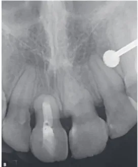 Figure 11 - A) Intraoral frontal view at 3-year follow up. B) Periapical radiograph at 3-year follow up.