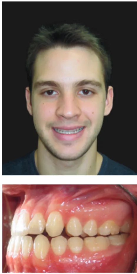 Figure 1 - Pre-treatment photographs showing  skeletal and dental Class III malocclusion.