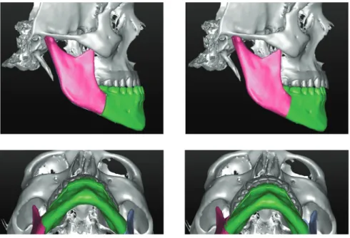 Figure 4 - Surgical planning of mandibular set- set-back.