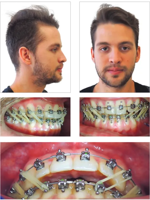 Figure 7 - Class III intermaxillary elastics.