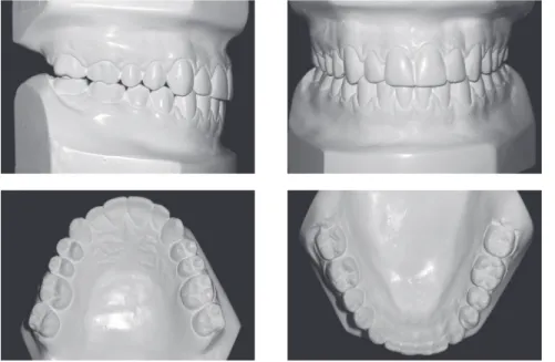 Figure 9 - Post-treatment dental casts.
