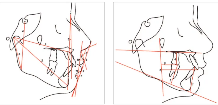 Figure 2  - Skeletal and soft tissue variables: 1) Co-A; 2) Co-Gn; 3) Co-Go; 
