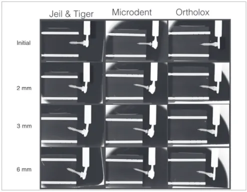 Figure 3  - X-ray sequence (initial, 2 mm, 3 mm  and 6 mm) of Jeil &amp; Tiger, Microdent and  Ortho-lox (left to the right) with double fastening wire.