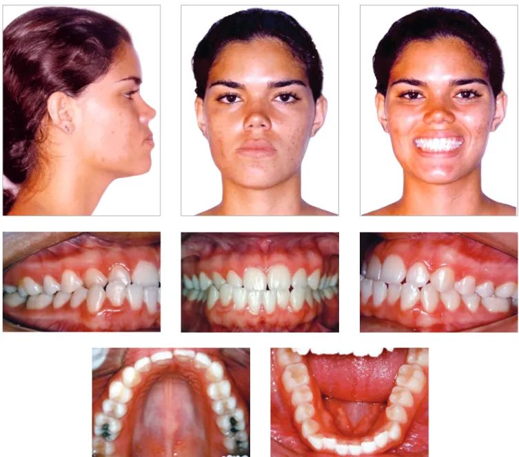 Figure 1 - Initial facial and intraoral photographs.