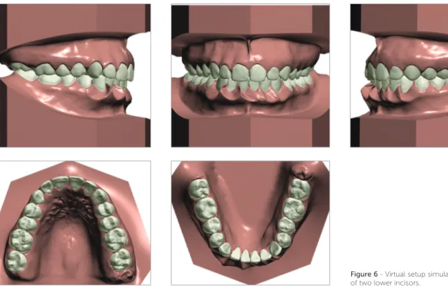 Figure 6 - Virtual setup simulating the extraction  of two lower incisors.