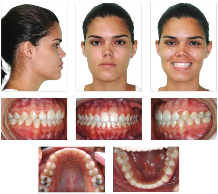Figure 10 - Facial and intraoral photographs two years after treatment completion.