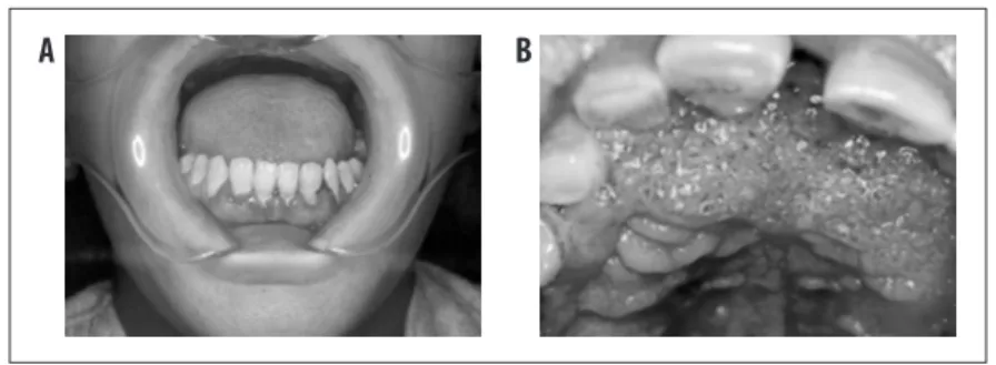 Figura 6 – Acometimento oral na forma crônica da paracoccidioidomicose