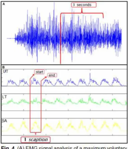 Fig. 4. (A) EMG signal analysis of a maximum voluntary isometric contraction; (B) Analysis of the EMG signal of the scaption movement; UT: Upper trapezius, LT  Lower trapezius, SA: Serratus anterior