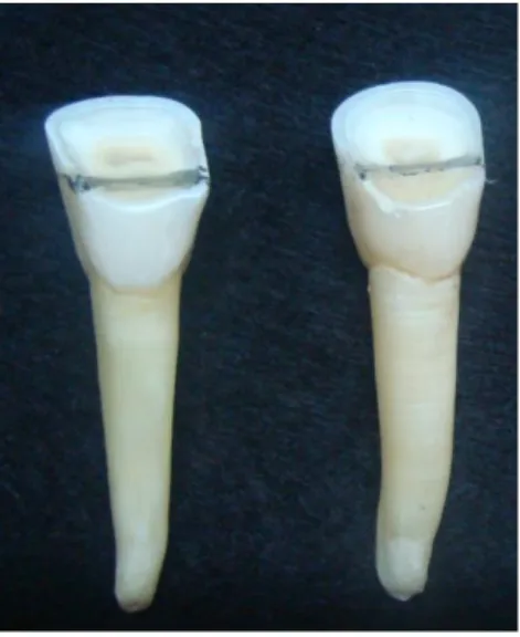 Figura 1- Dentes extraídos com desgaste coronário. 