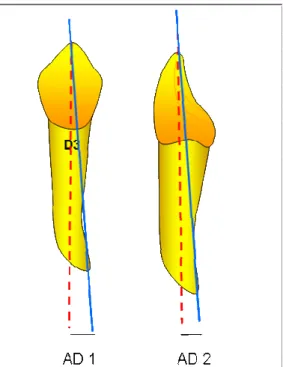 Figura  3.  Esquema  ilustrativo  das  características  do  alinhamento  dental  observadas  na  seleção  dos  dentes  coletados