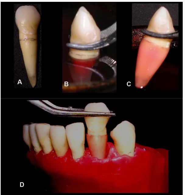 Figura 6. Sequência para simulação do ligamento periodontal. A- demarcação  distando  2  mm  apicalmente  a  junção  amelocementária;  B-  inclusão  em  cera  utilidade;  C-  alívio  em  cera  da  porção  radicular;  D-  raízes  lubrificadas  e  incluídas 