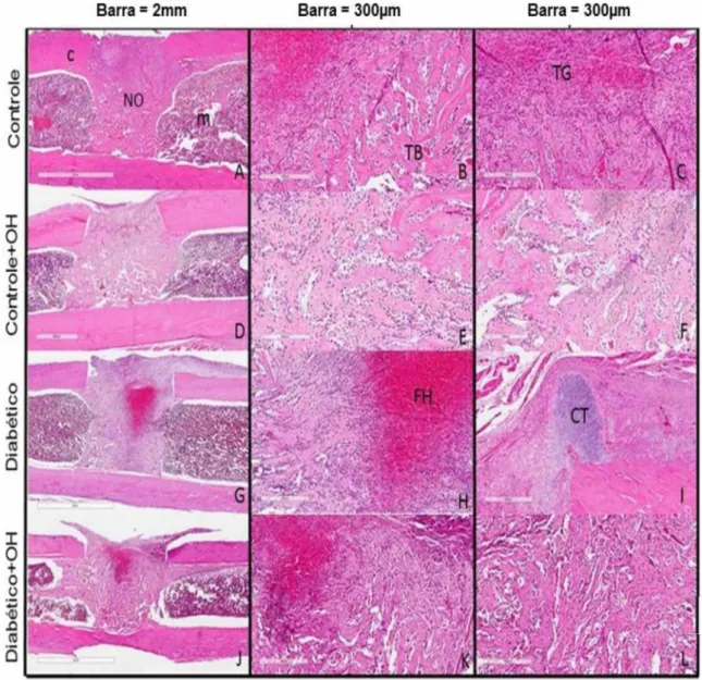 Figura 9:  Imagem  histológica de corte longitudinal  de fêmur mostrando:  cortical  (C),  medula óssea (M) e neoformação óssea (NO), trabécula óssea (TB), cartilagem (CT),  tecido de granulação (TG), foco de hemorragia (FH)